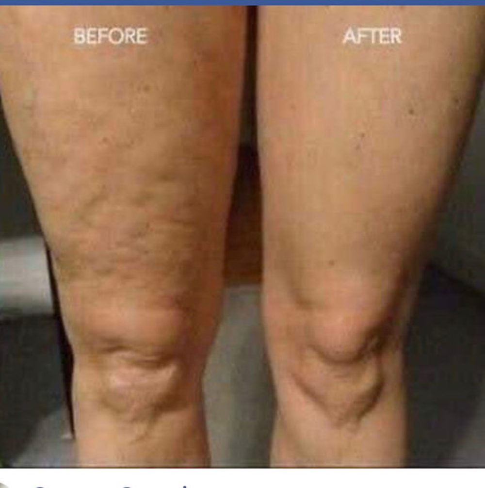 Before and after photo of a woman's legs, showing improvement after treatment for varicose veins.